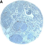 Correlation of tumor-associated macrophages and clinicopathological factors in Wilms tumor