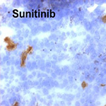 Sunitinib significantly suppresses the proliferation, migration, apoptosis resistance, tumor angiogenesis and growth of triple-negative breast cancers but increases breast cancer stem cells