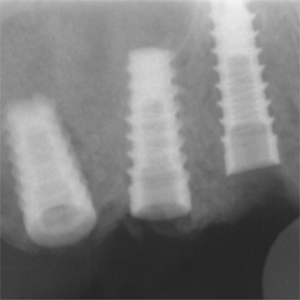 Multidisciplinary approach to maximize angiogenesis and wound healing using piezoelectric surgery, concentrated growth factors and photobiomodulation for dental implant placement surgery involving lateral wall sinus lift: two case reports.