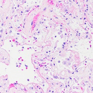 SARS-CoV2 diffuse alveolar damage (DAD)
